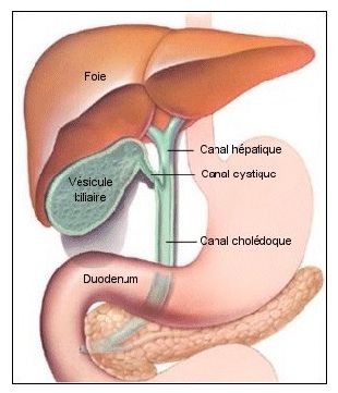 Gallstones