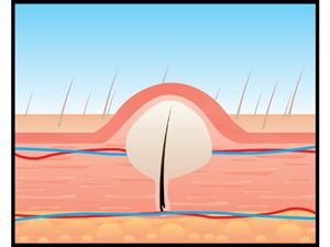 Folliculitis - Ingrown hair