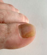 Nail Mycosis