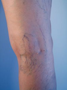 Varicose Veins